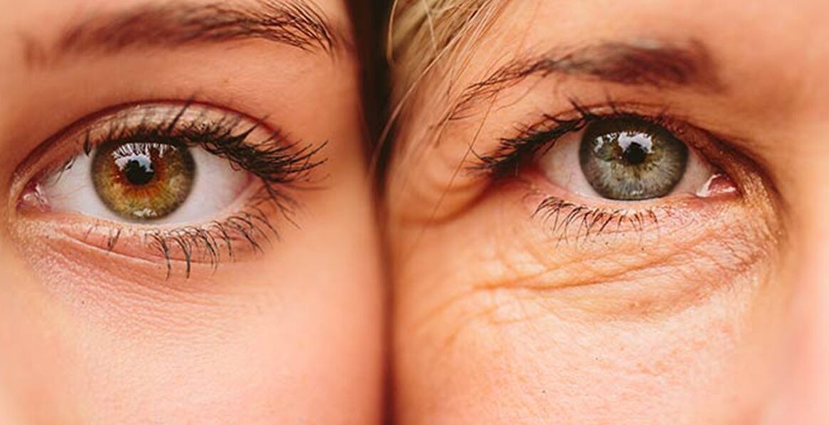 Ytre tegn på aldring av huden rundt øynene hos to kvinner i forskjellige aldre