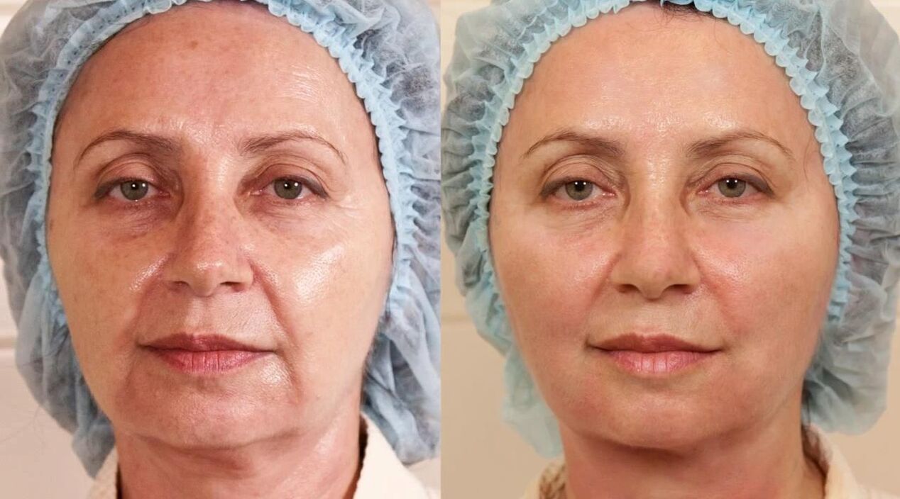 før og etter bilder av ansiktsløftning