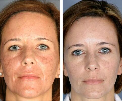 Før og etter fraksjonell ansikts termolyse