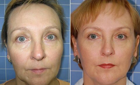 Før og etter fraksjonell laser ansiktsforyngelse