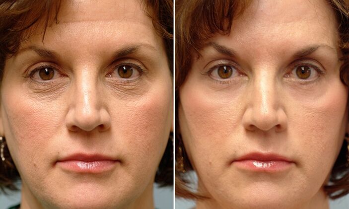 ansiktet før og etter laserfraksjonell foryngelse